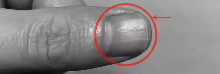 울퉁불퉁-손톱-세로줄-원인과-증상-단순한-노화일까-몸이-보내는-건강-신호일까