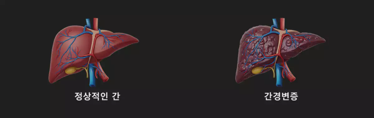 간경화-liver-cirrhosis