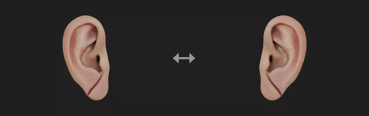 귓볼-주름-프랭크-징후