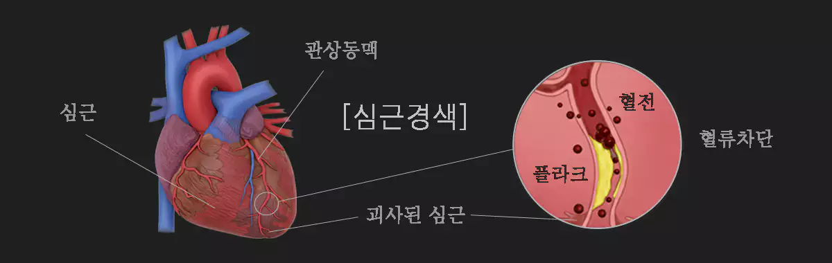 심근경색증-myocardial-infarction