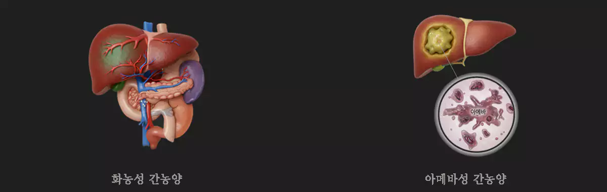 간농양-liver-abscess